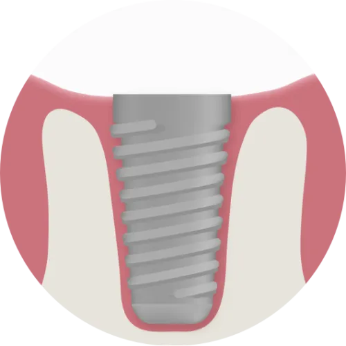 implantat-1