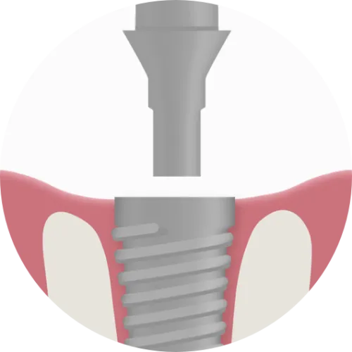 implantat-2