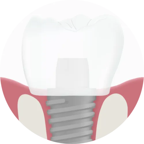implantat-3